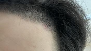 빠진모낭..