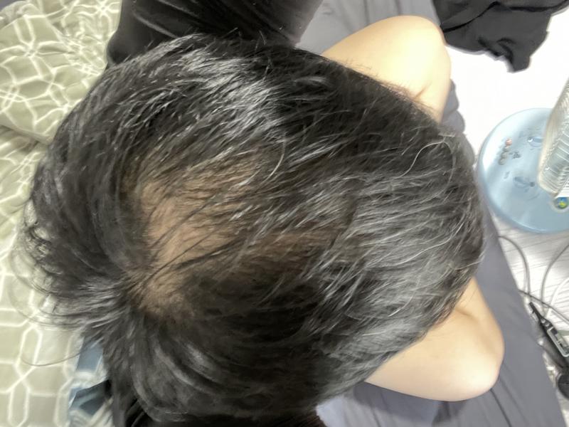 25살 정수리 탈모입니다 저랑 비슷하신분 같이 고민해요!!