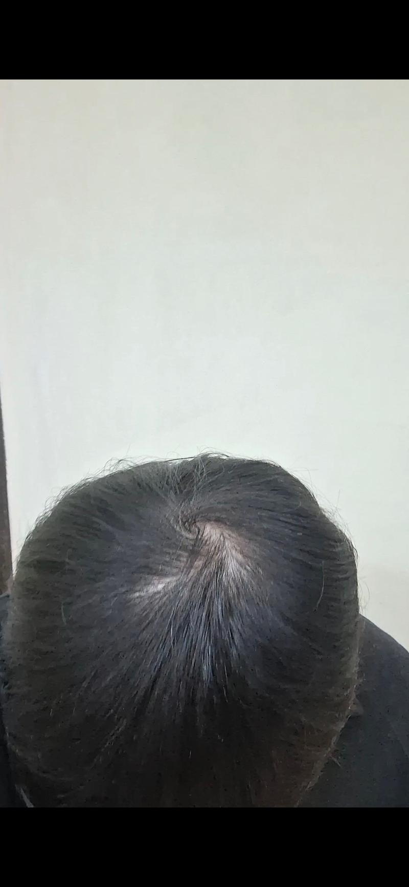 피나스테리드 프로페시아 1년 후기입니다..