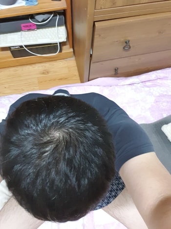 조합약+주사 3개월차(치료 9개월차)