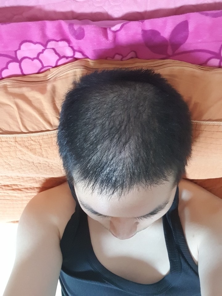 아보다트 복용 6개월차