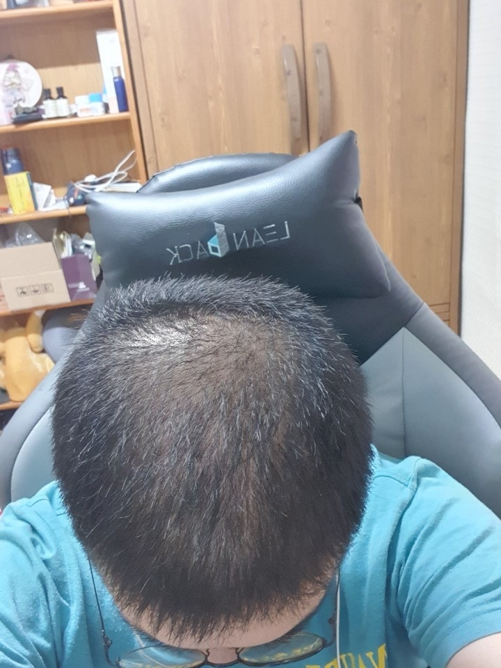 조합약+주사 1개월차 (치료 7개월차)