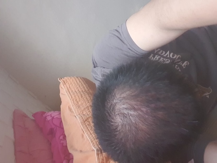 아보다트 복용 6개월차