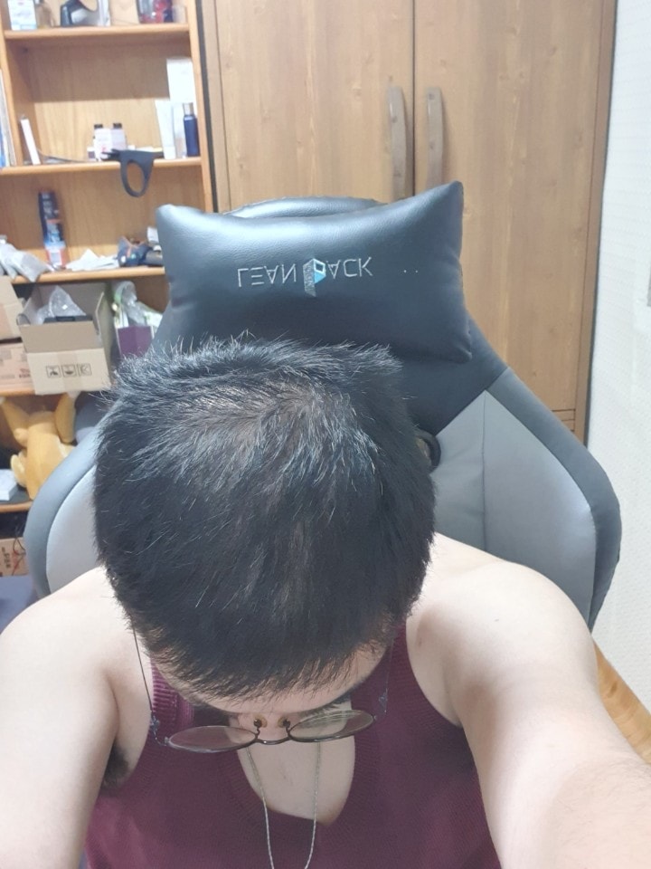 조합약+주사 2개월차(치료 8개월차)