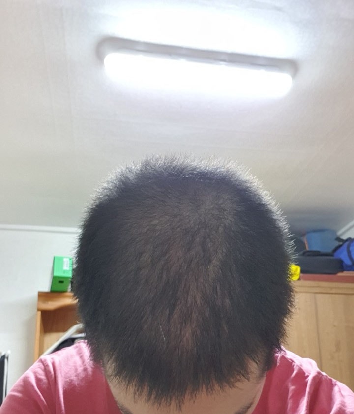 아보다트 복용 6개월차