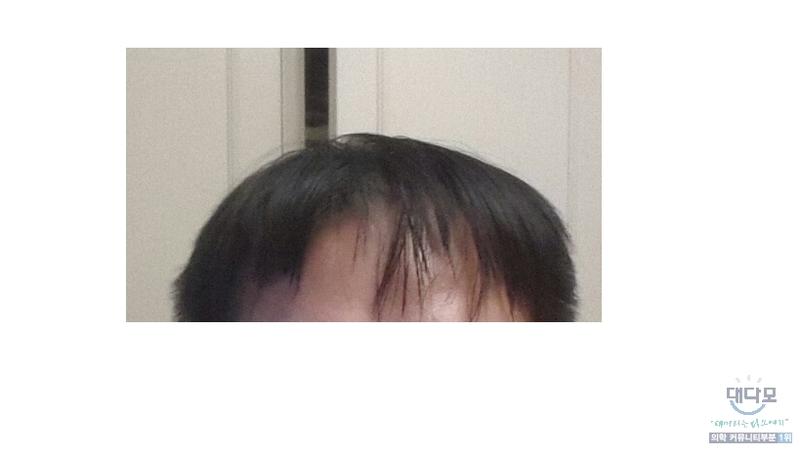 모발이식 1년 기념으로 사진 올립니다