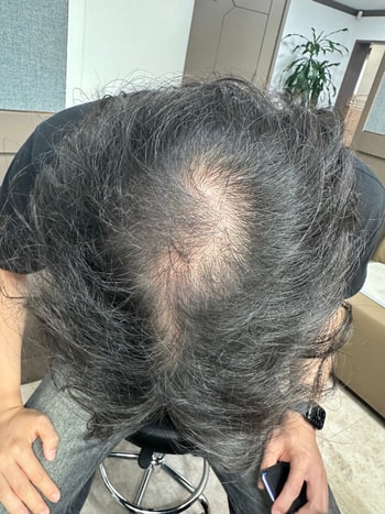 처방받고 복용한지 몇 주 후 종로성지원장성님께서 찍어주심
