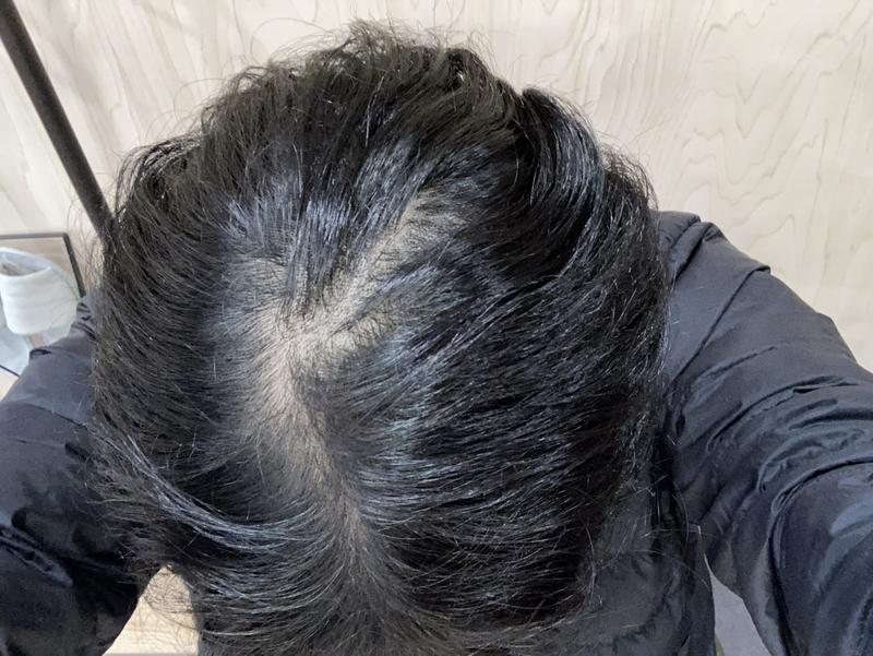 정수리탈모 이정도면 수술해주나요?