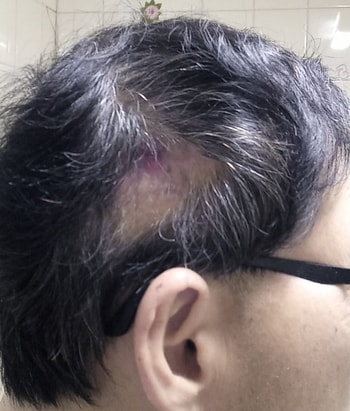 전체적인 모습. 공백부위가 너무 커서 하루하루 걱정입니다 ㅡㅜ