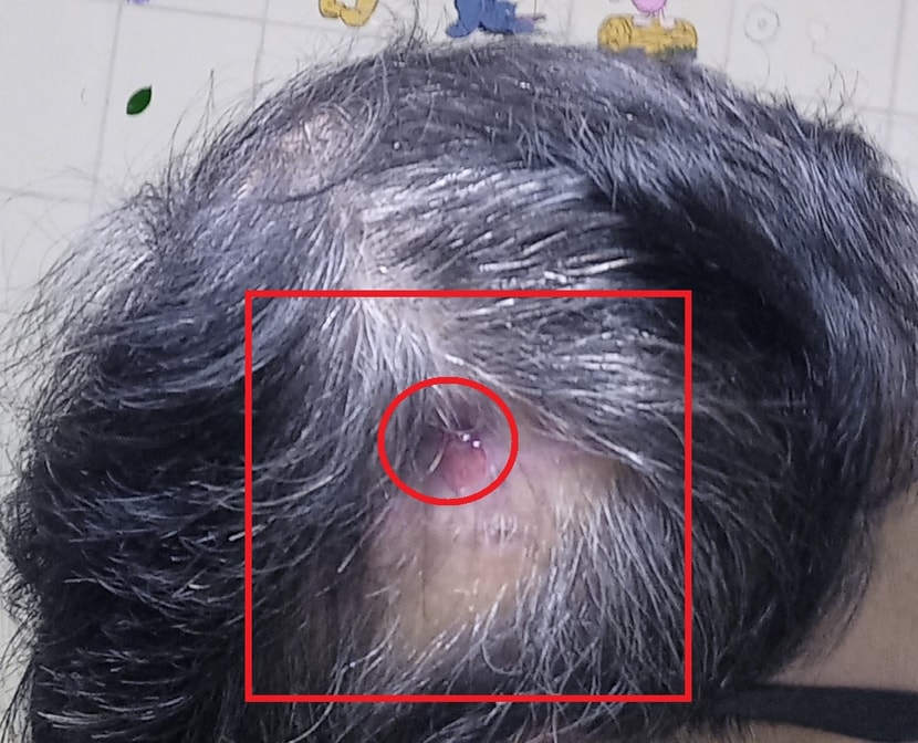 동그라미 부위 딱지 떨어지고 주변 공백부위