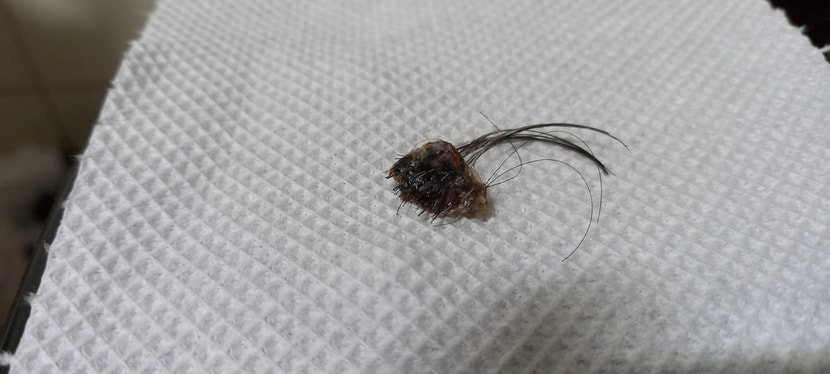 떨어진 딱지. 모낭이 붙어 있음