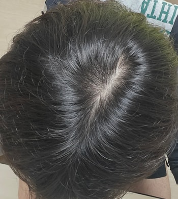 정수리 2