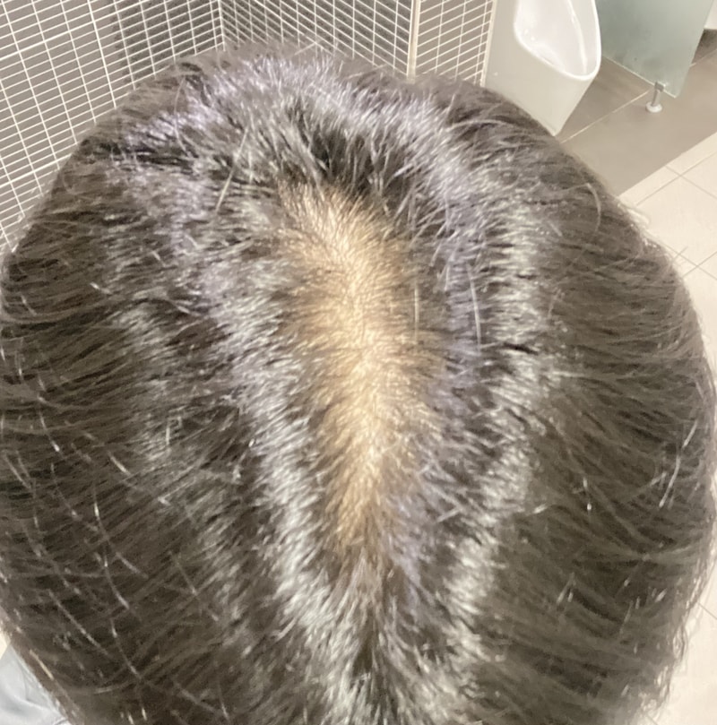 I have a question about hair loss medicine