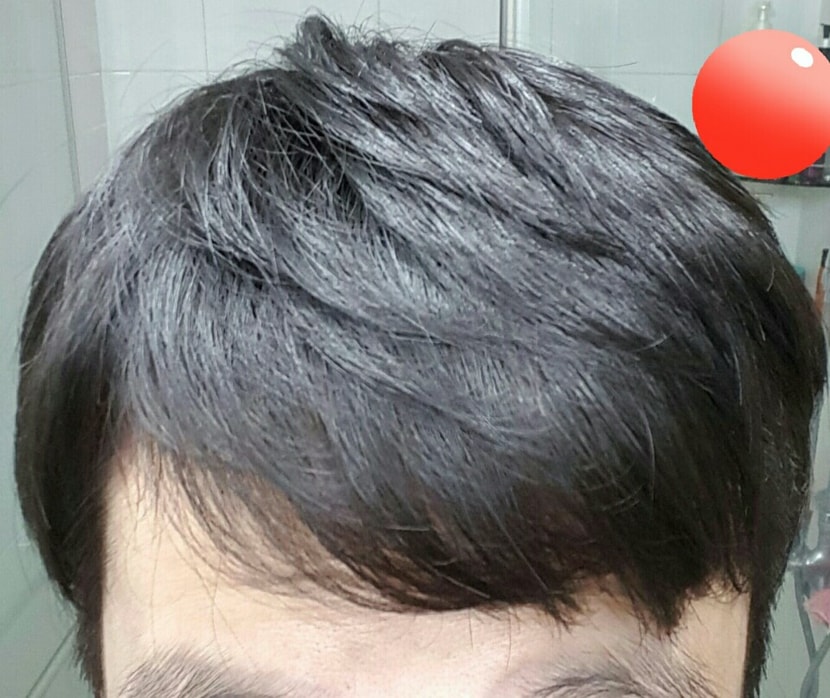 사진에서 보듯이 만약 이마가좁아서 눈썹이 앞머리 바로 밑에 존재했다면 이 사진은 크게 탈모인처럼 안보일것입니다.