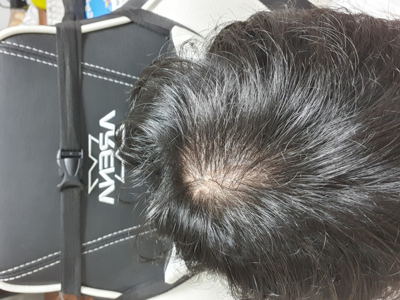 조합약 3개월 변화