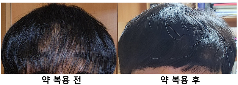 After taking the medicine, my hair and hair thickness improved a lot.