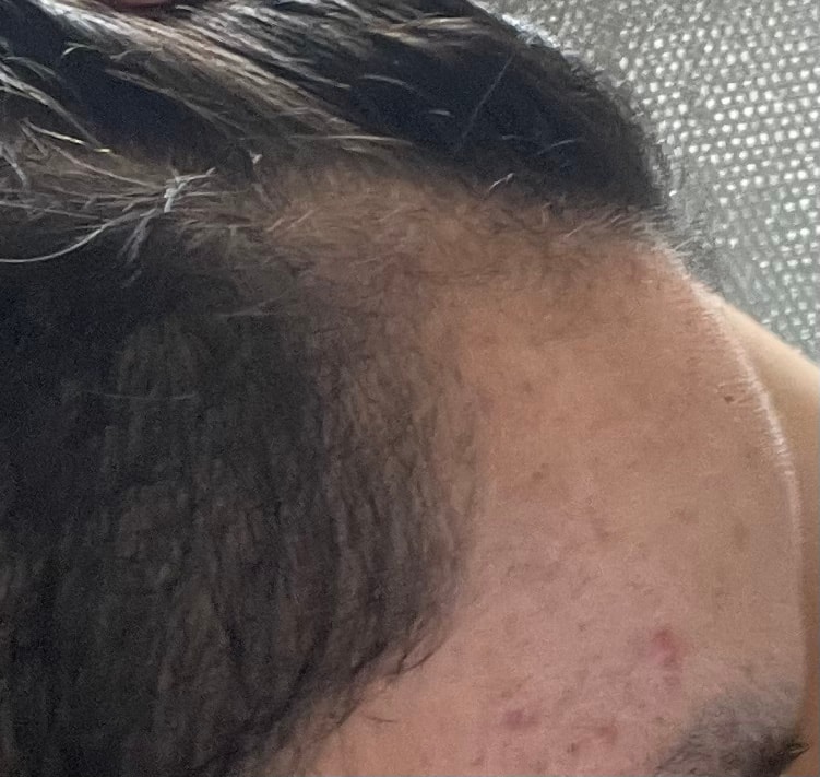 오늘 찍은 이마 옆