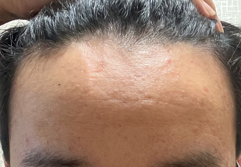 오늘 찍은 이마