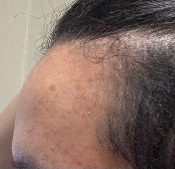 오늘 찍은 이마 옆