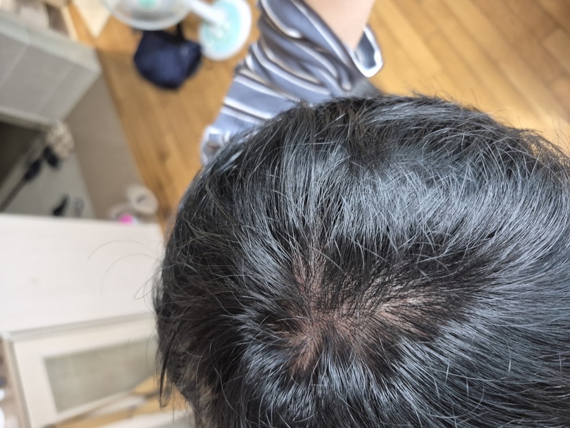 12일 전 두피 사진