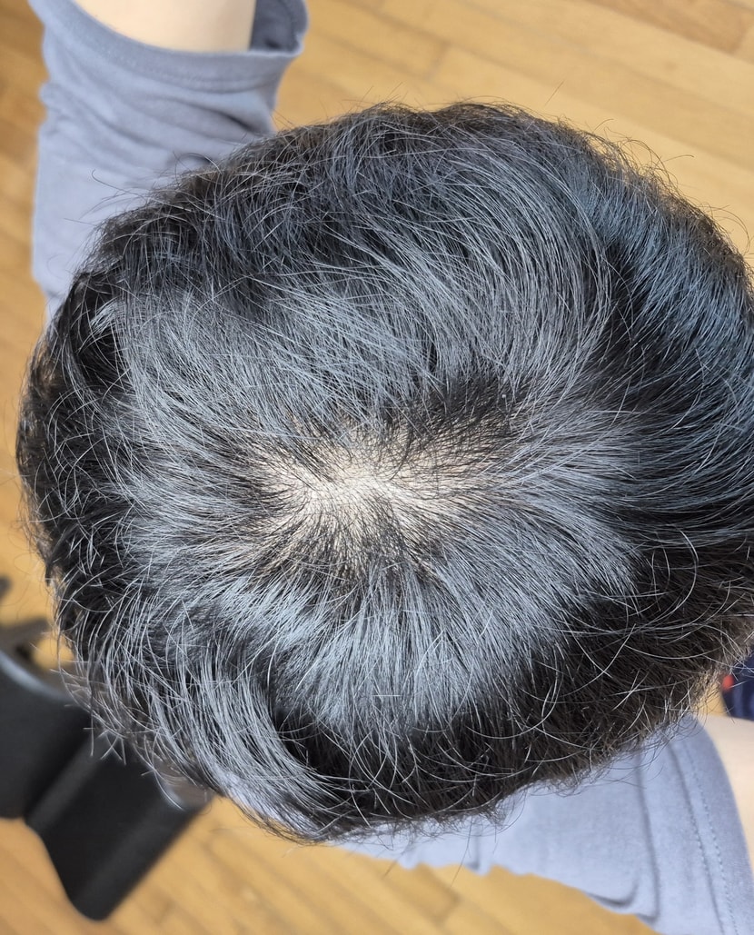 조금 좋아진 두피 사진