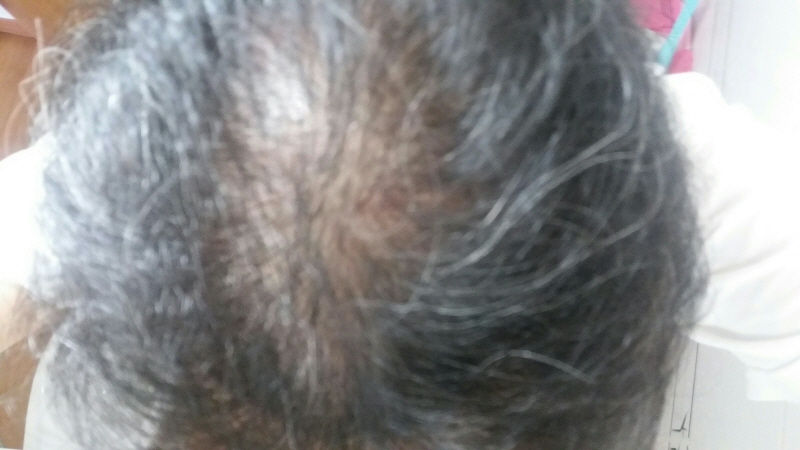 6월 머리 감은후 정수리