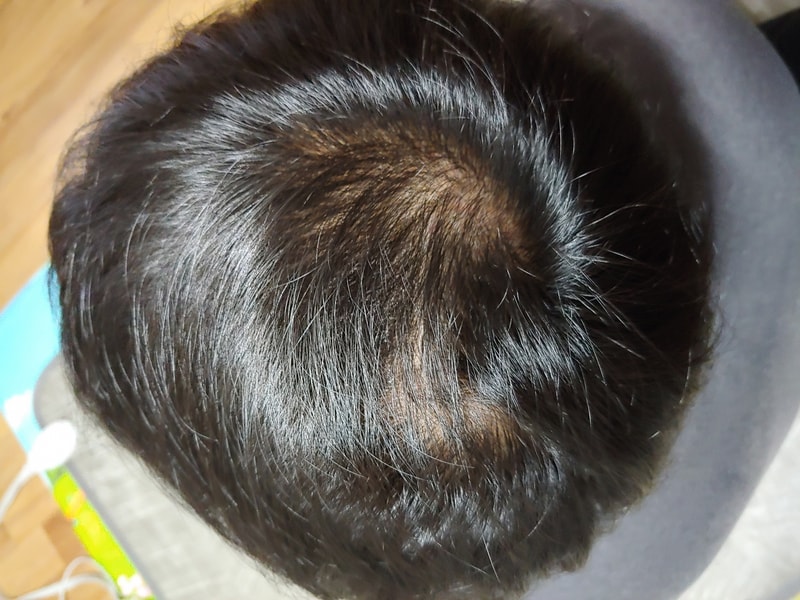 탈모 진행상태를 알수있을까요?