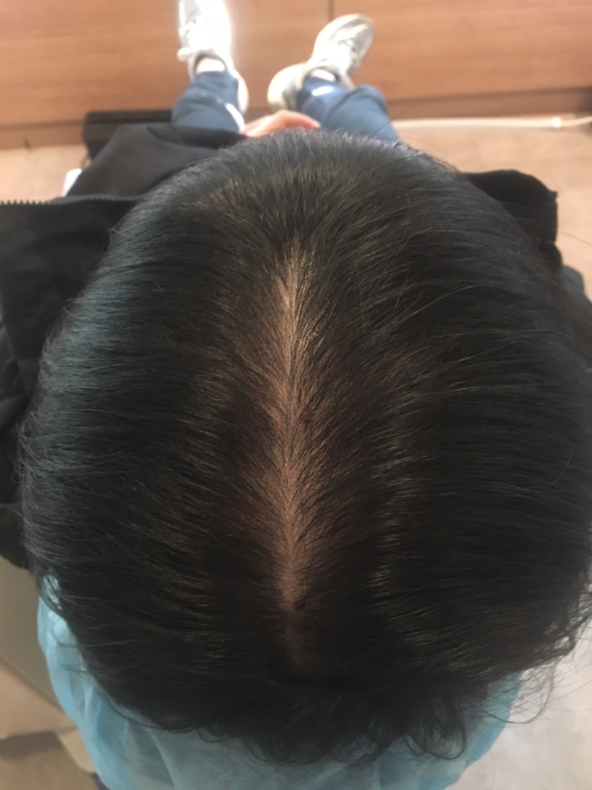 보톡스+엑소좀 치료 6개월후 