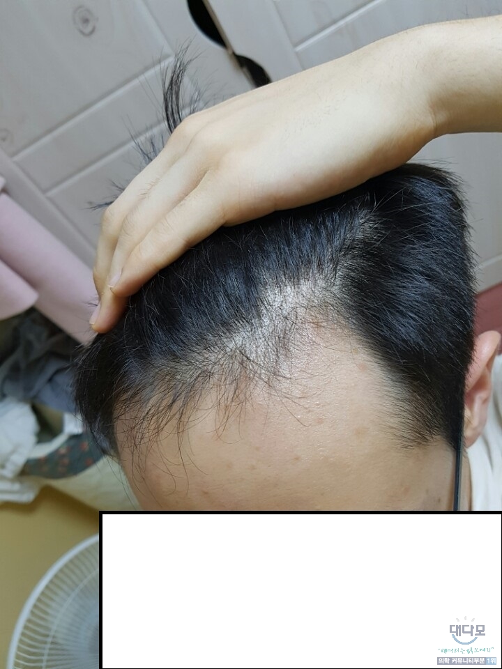 4개월 엠자 좌측