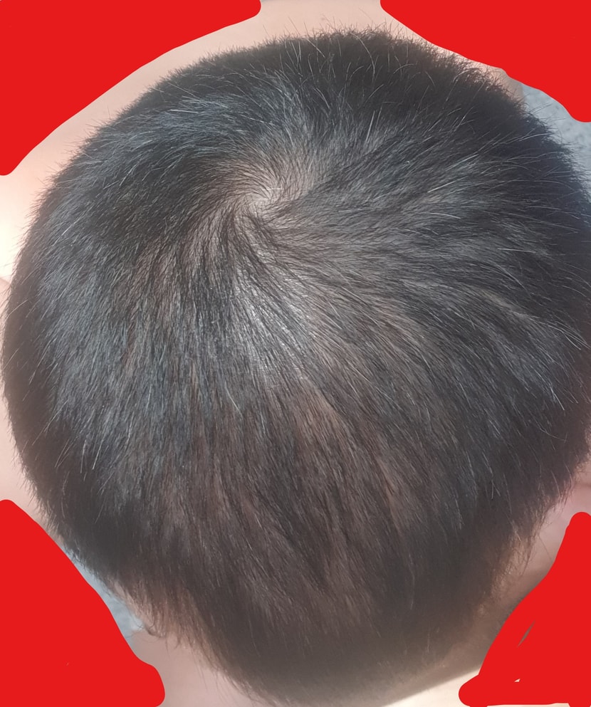 정수리 22년2월10일 - 주사치료 2회차