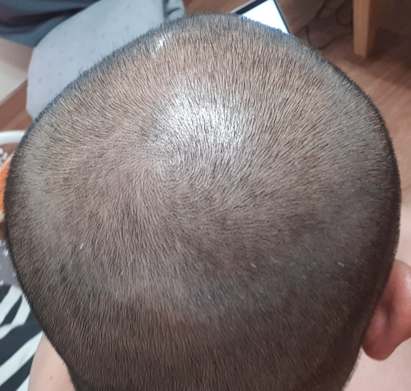 I just found out that I have hair loss at 40 years old. -2