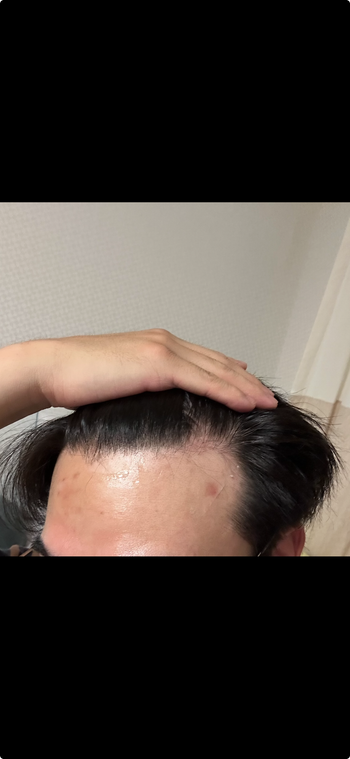 며칠 전 약 재복용 4주차입니다 ㅠ