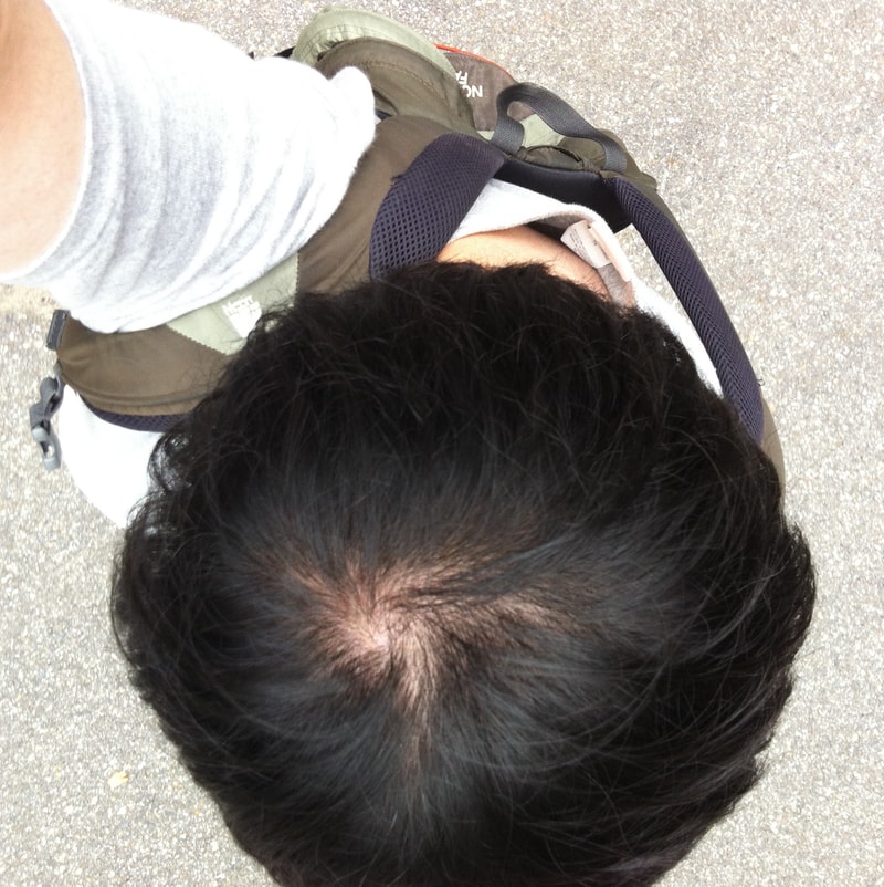 미녹정 4달 차 후기(나아졌나요?)