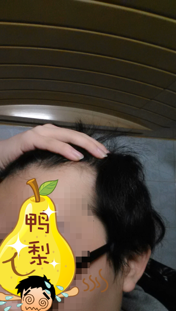 전역후 탈모진행 앞머리라인