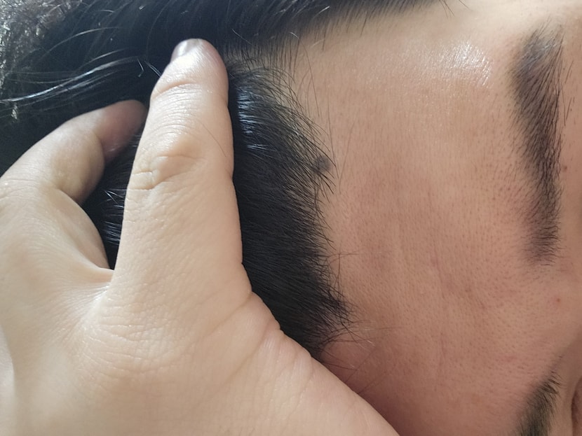 오른쪽 오늘 찍은 이마입니다 태어났을때 모양은m자였습니다!!