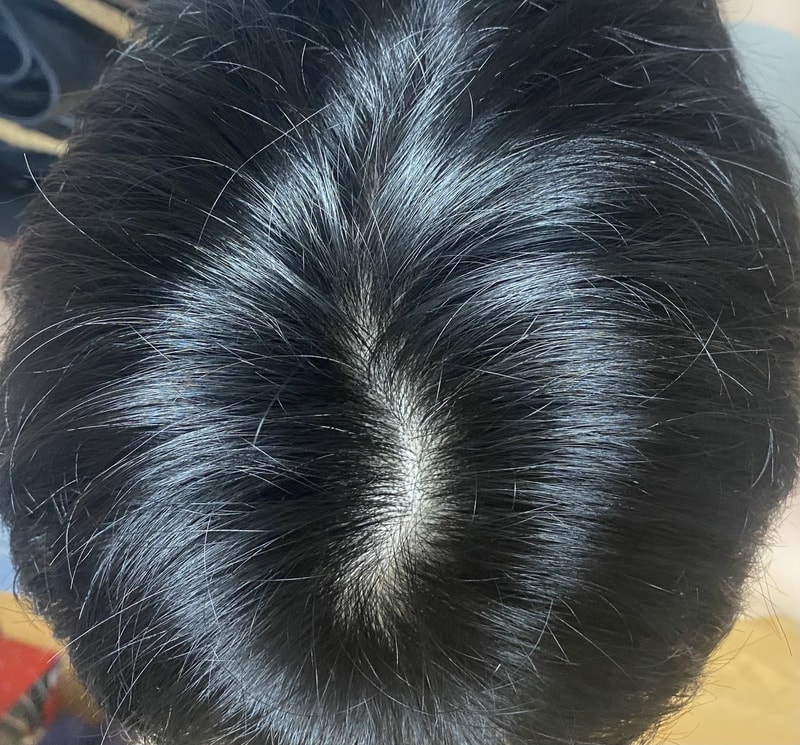薄毛初期か診断をお願いします