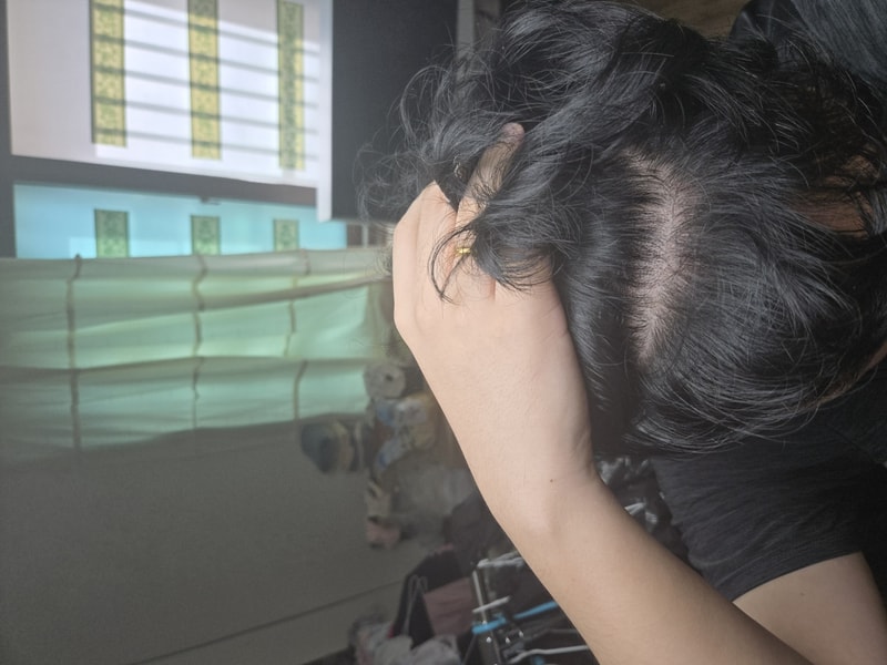 전두부 탈모 많이심한가요?