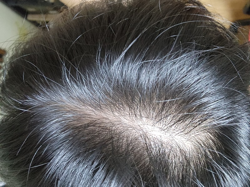 最近髪の毛がもっと抜けるようですが原因は何でしょうか