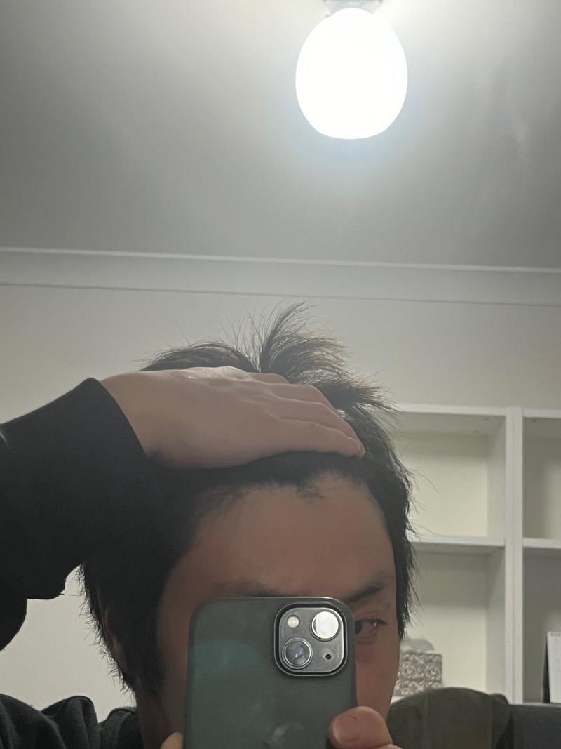 남성형 탈모 초기일까요?