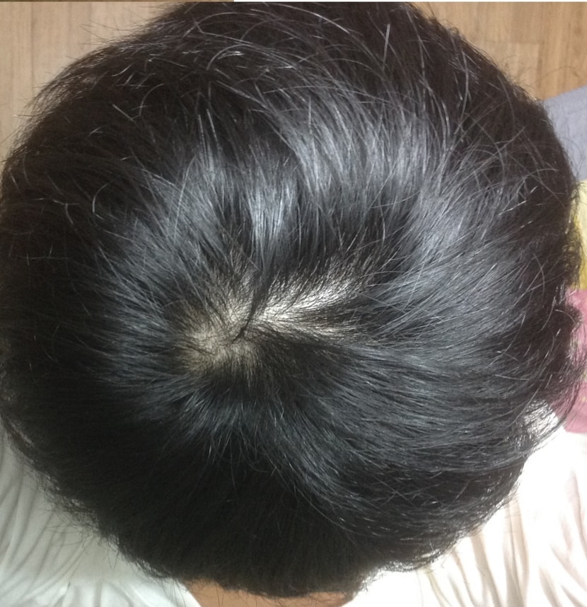정수리2