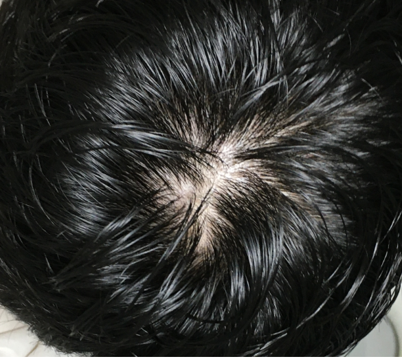 피나계열을 계속 먹는게 좋을지 문의드립니다.