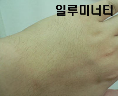 미녹시딜정 부작용