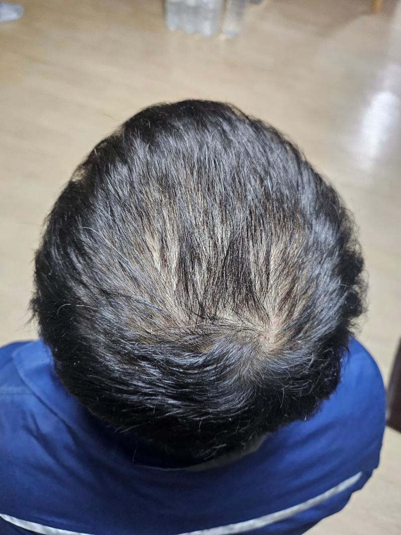 정수리 암흑기 끝난것 맞나요?