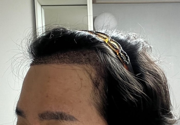 2주 됐을때 지문샴푸 전