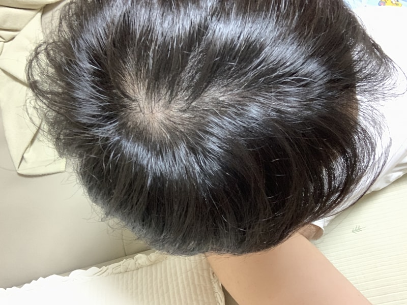 정수리 탈모인가요 ?