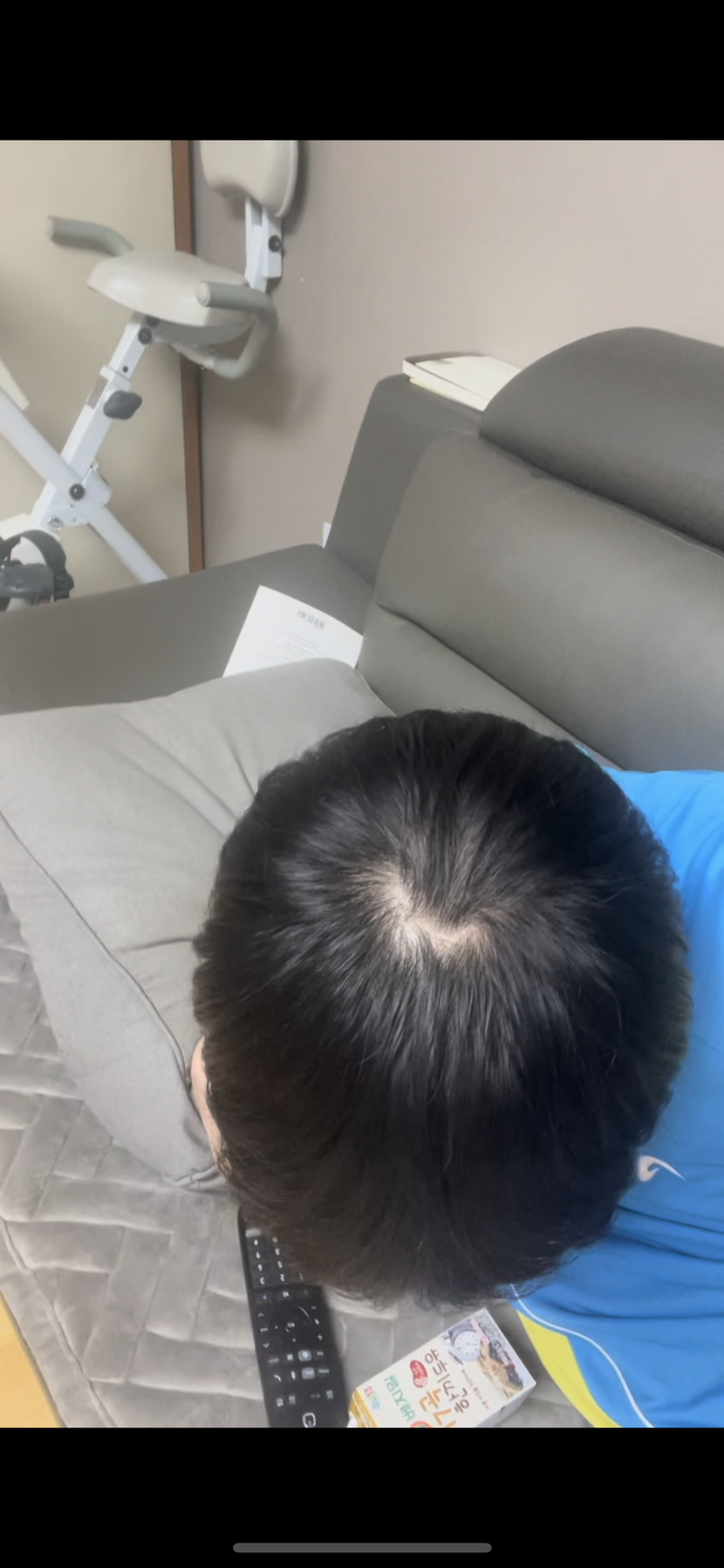 탈모 진단받기 1~2달전 사진입니다.