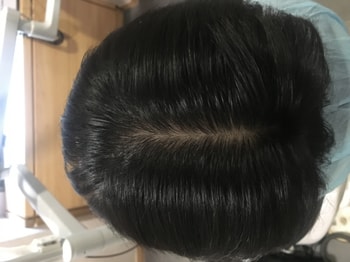 이 사진은 약 + 치료받은지 6개월? 1년정도 되었을 때고, 지금은 사실 탈모에 대해 크게 신경쓰지 않고 생활합니다. 