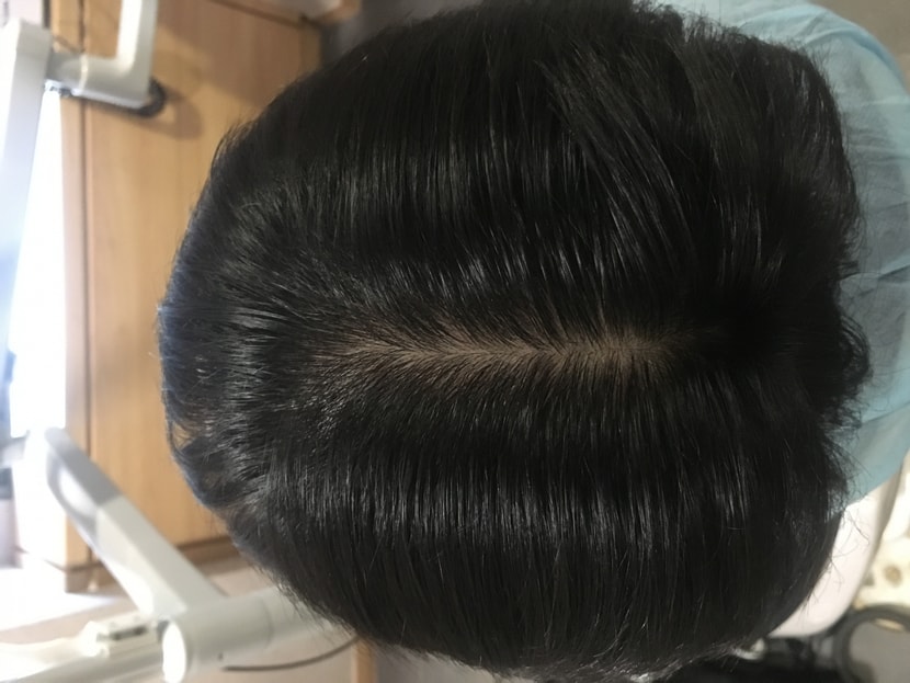 이 사진은 약 + 치료받은지 6개월? 1년정도 되었을 때고, 지금은 사실 탈모에 대해 크게 신경쓰지 않고 생활합니다. 