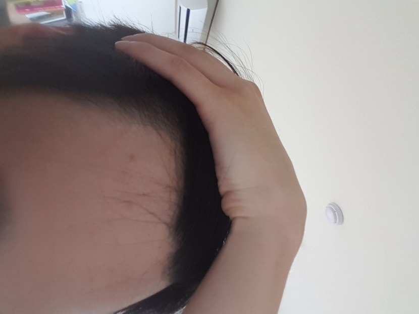 오른쪽이마입니다.