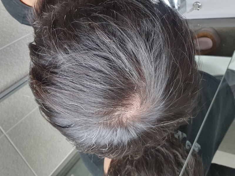 有解决脂溢性头皮炎后头发变松的人吗？